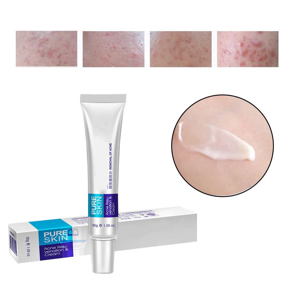 pimple remove night cream