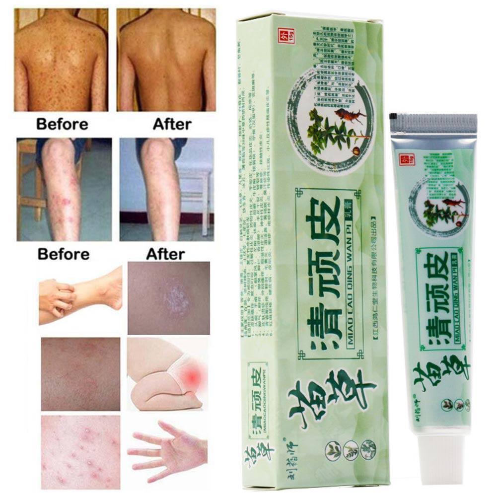 Buy Herbal Psoriasis Ointment Dermatitis Eczema Treatment Skin Cream ...