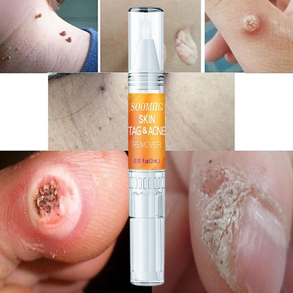 3ml Skin Face Tag Remover Genital Wart Treatment Removal Mole