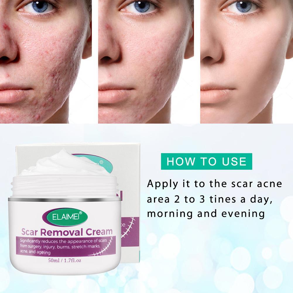 acne cream burns