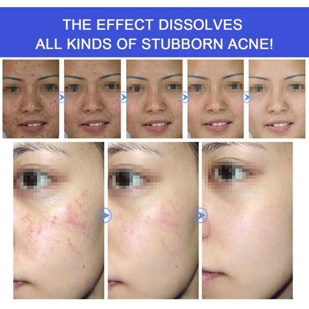 Первая стадия акне фото Купить Средство Unbranded multi/effect Repair Acne Pits Acne Marks Acne Closed M