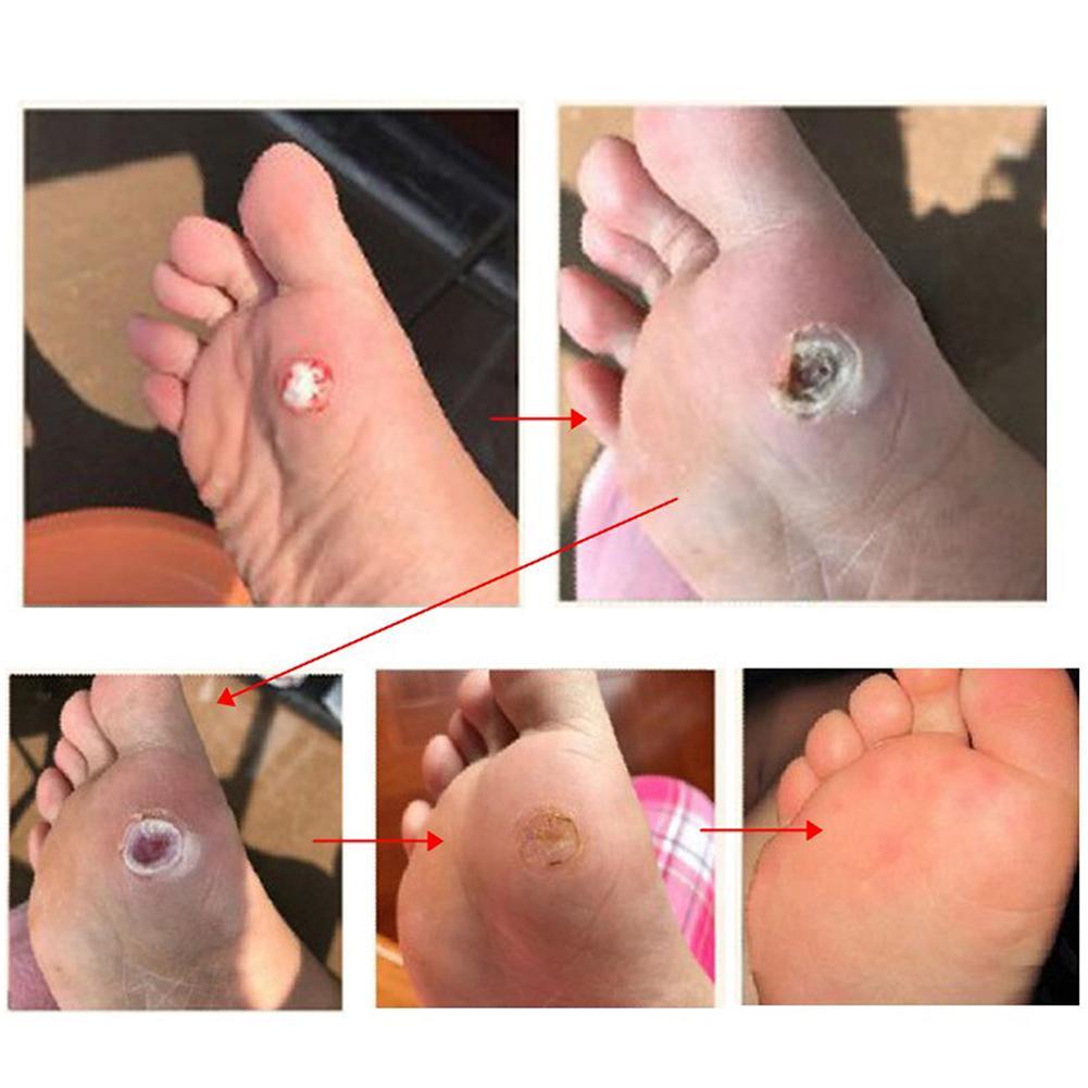 Foot Care Tool For Removing Corn Killer Calluses And Plantar Warts S8w9
