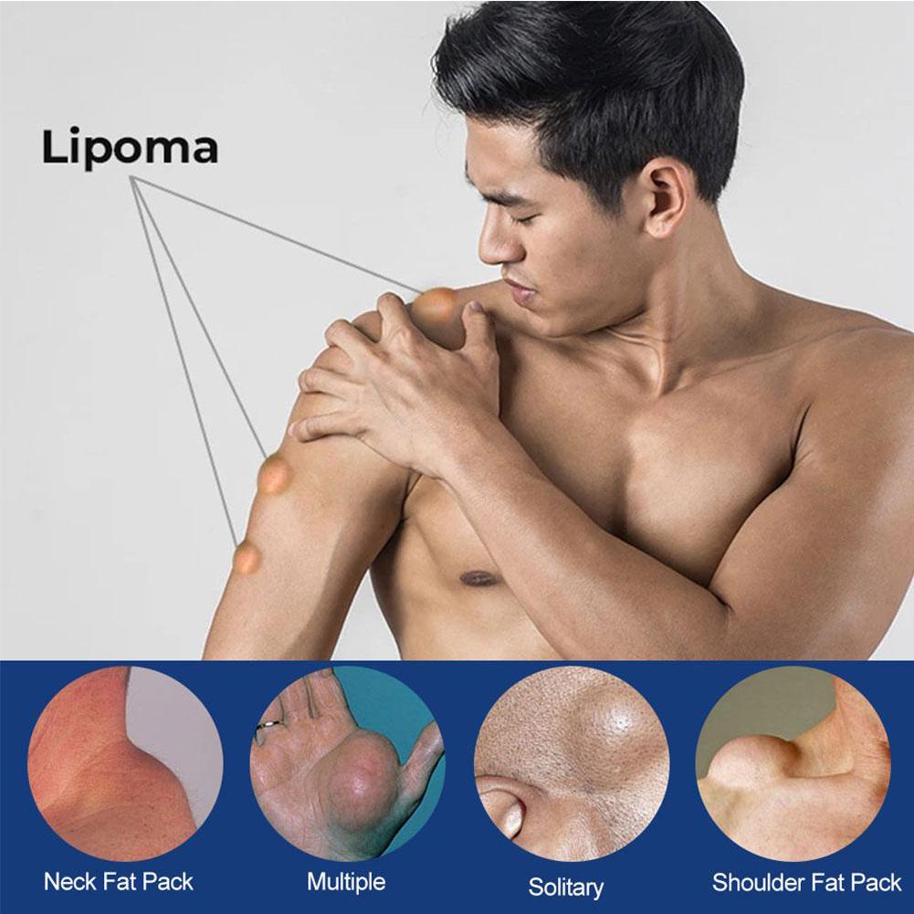 Crème Lipomas Cream 20g - Action Antibactérienne, Pour Les Lipomes Et Cellulite
